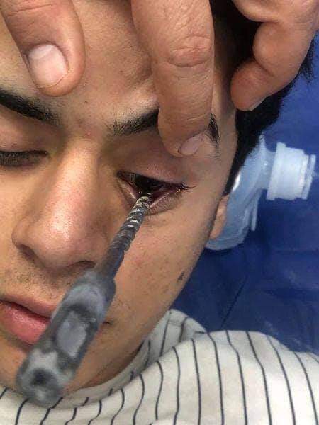 وێنە.. درێلێک دەچێ بە چاوی گەنجێکدا