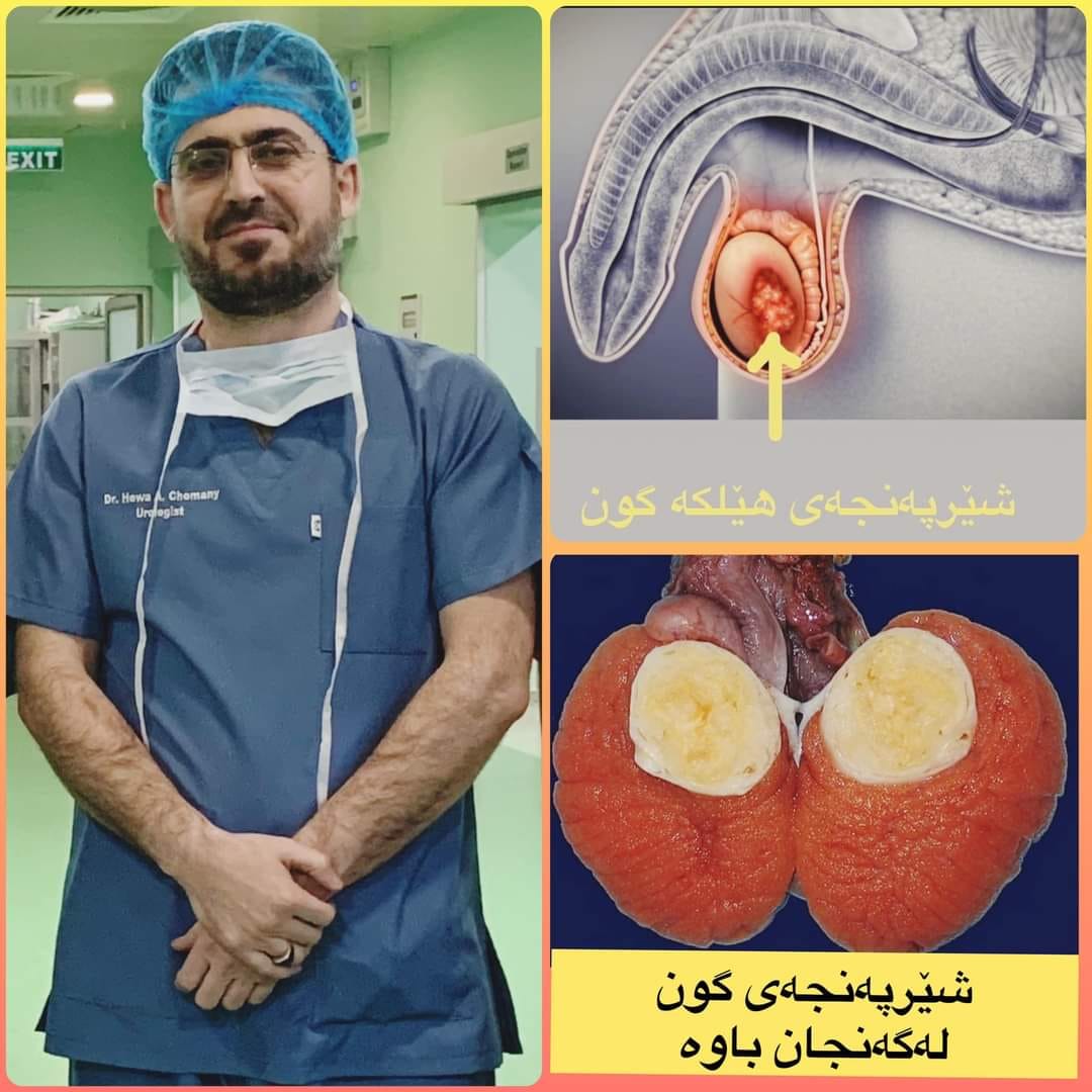 چۆن بزانم شێرپەنجەی گەنجان "شێرپەنجەی گون"م نیە؟