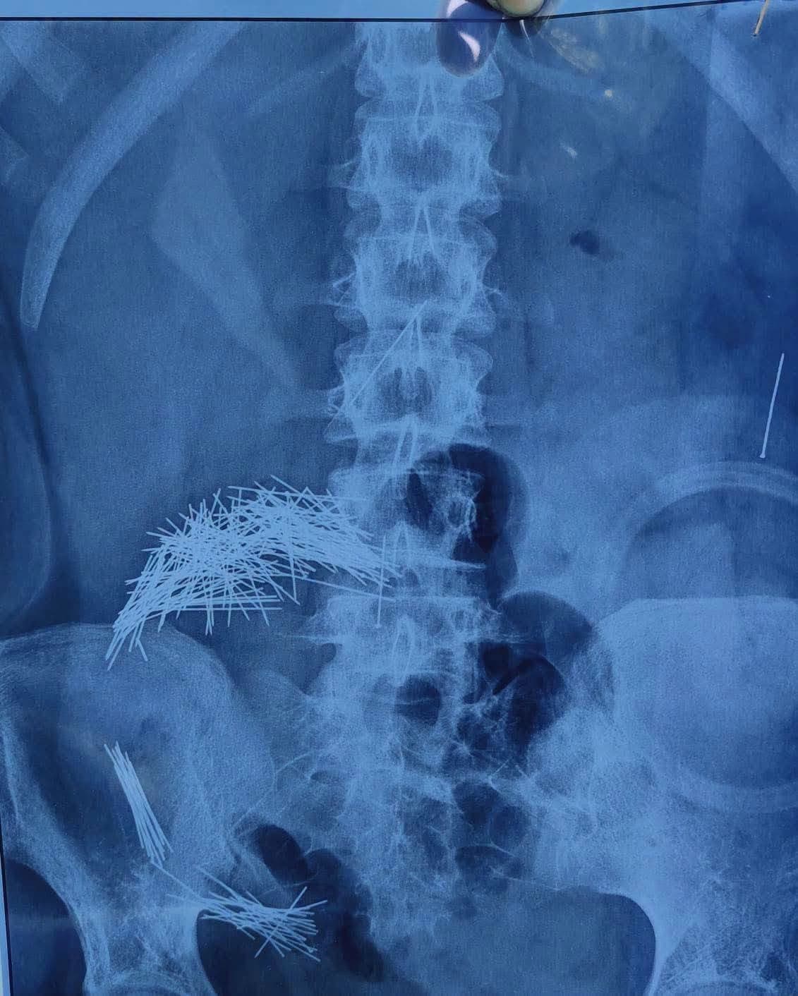 لە سەلاحەددین 214 دەرزی لە سکی کەسێک دەردەهێندرێن